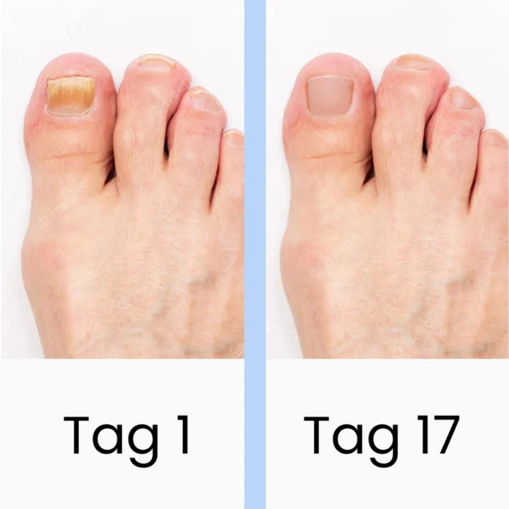 DermaBlue™ Therapiegerät gegen Nagelpilz