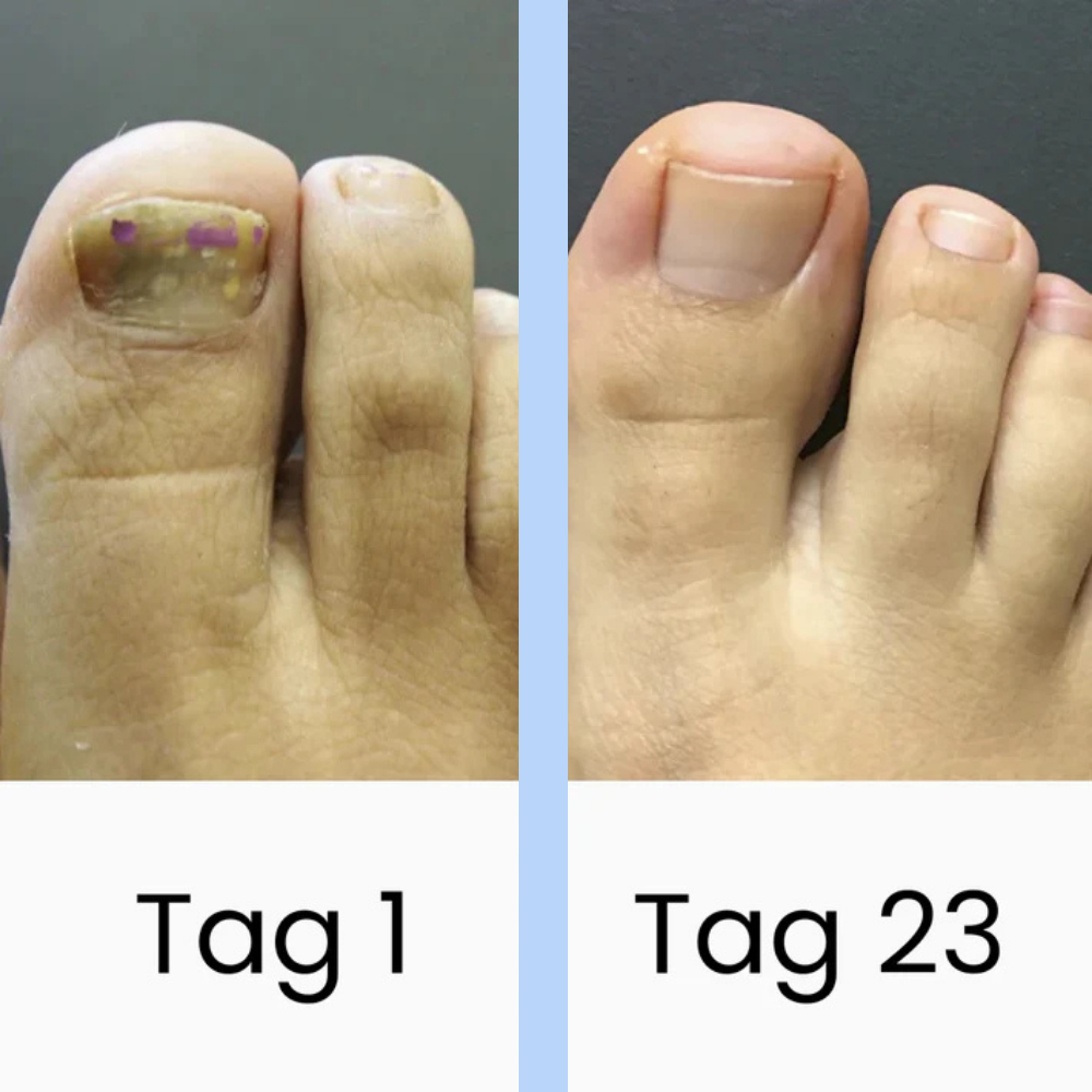 DermaBlue™ Therapiegerät gegen Nagelpilz