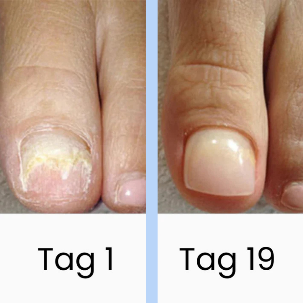 DermaBlue™ Blaulicht Therapiegerät gegen Nagelpilz